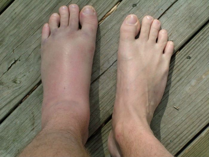 Опухание стопы Опухание стопы