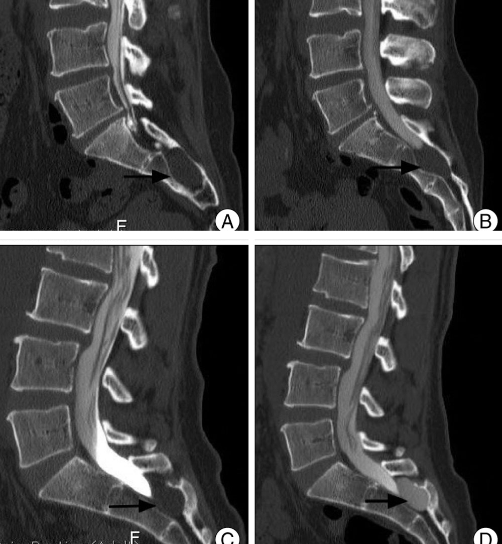 Опухоль копчика на снимке Опухоль копчика на снимке