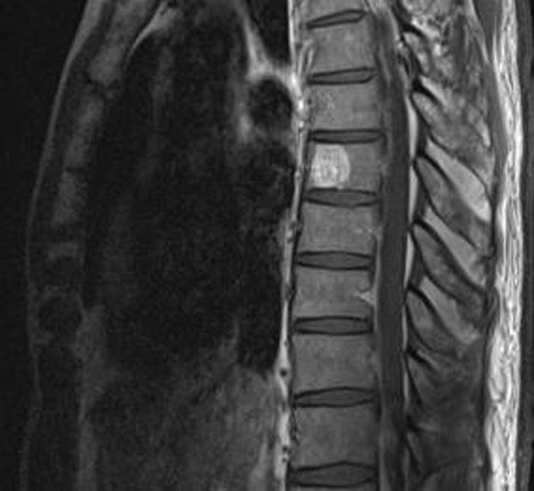 Опухоль позвоночника на снимке Опухоль позвоночника на снимке