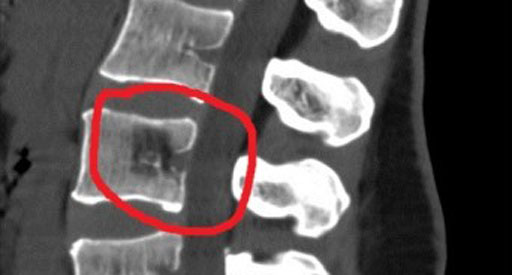 Опухоль позвонка на МРТ Опухоль позвонка на МРТ