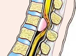 Опухоль позвоночника Опухоль позвоночника