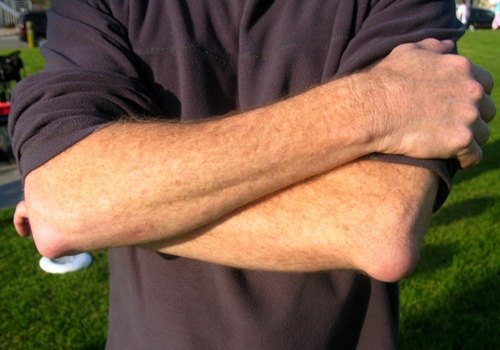 Подкожная опухоль при бурсите локтевого сустава Подкожная опухоль при бурсите локтевого сустава