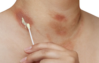 Лечение пятен Медикаментозное и народное лечение пятен похожих на ожог