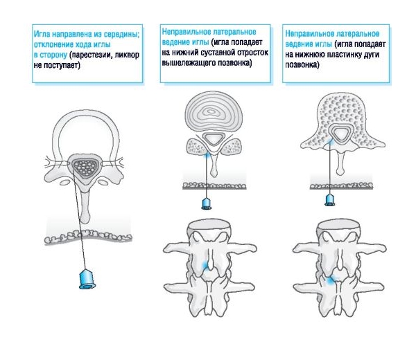 Ошибки при введении эпидуральной анестезии Ошибки при введении эпидуральной анестезии