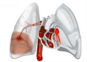 Кровотечение при стернальной пункции Кровотечение при стернальной пункции