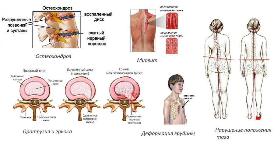 Осложнения кифосколиоза Осложнения кифосколиоза