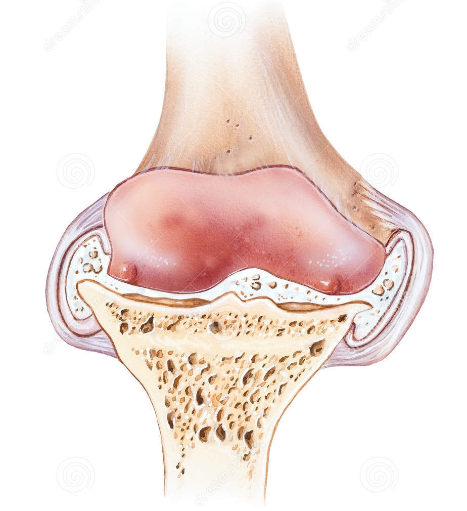 Остеоартрит Остеоартрит