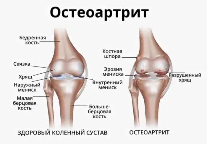 остеоартрит
