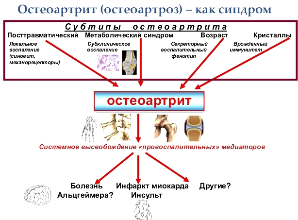 Остеоартрит Остеоартрит