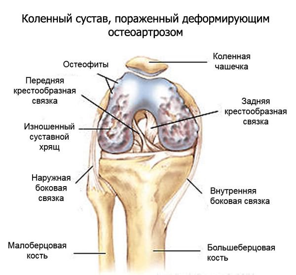 Остеоартроз Остеоартроз