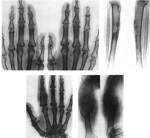 Остеодистрофия Остеодистрофия