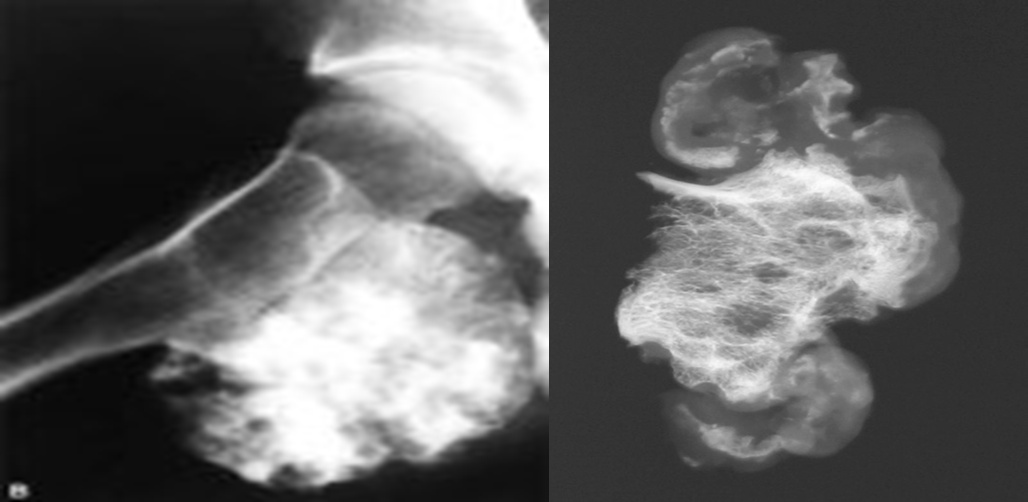 Остеохондрома на рентген снимке Остеохондрома на рентген снимке