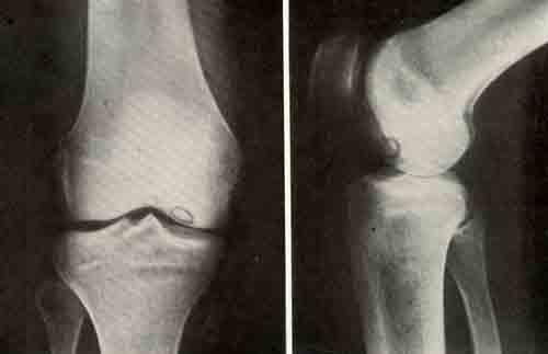 Остеохондропатия сустава на рентген снимке Остеохондропатия сустава на рентген снимке