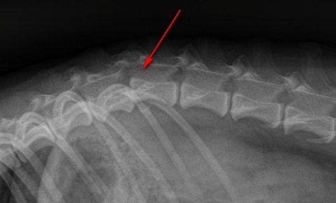Остеохондроз грудного отдела позвоночника на рентгене Остеохондроз грудного отдела позвоночника на рентгене