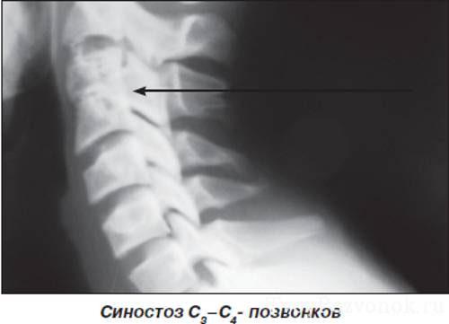 Остеохондроз шейного отдела на рентгене Остеохондроз шейного отдела на рентгене