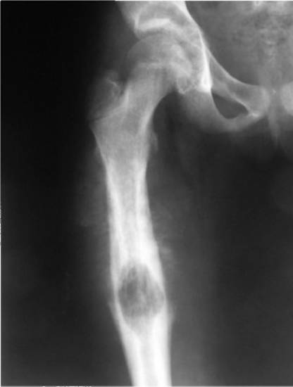 МРТ диагностика бедра МРТ диагностика бедра