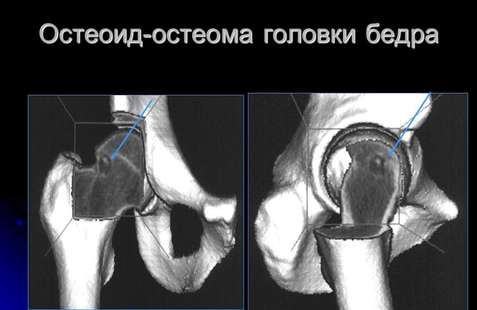 Остеоид-остеома головки бедра Остеоид-остеома головки бедра
