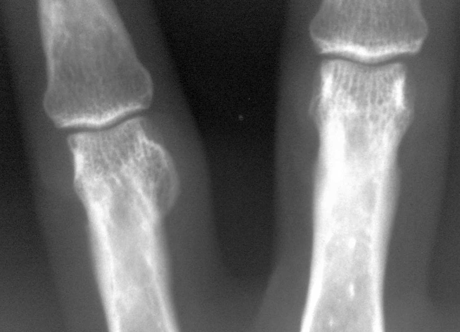 Остеома на рентген снимке Остеома на рентген снимке