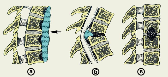 Остеомиелит позвоночника Остеомиелит позвоночника