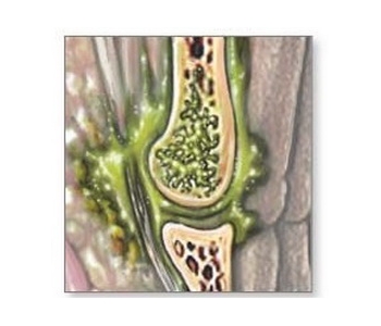 Остеомиелит на фоне инфекции Остеомиелит на фоне инфекции