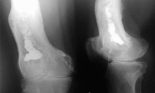 Остеомиелит на рентген снимке Остеомиелит на рентген снимке