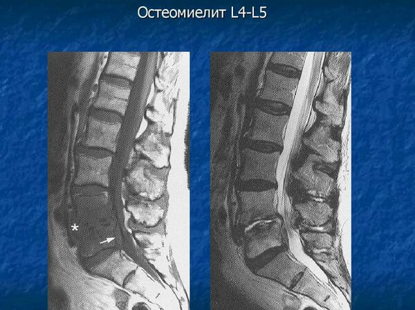 Диагностика остеомиелита на КТ Диагностика остеомиелита на КТ