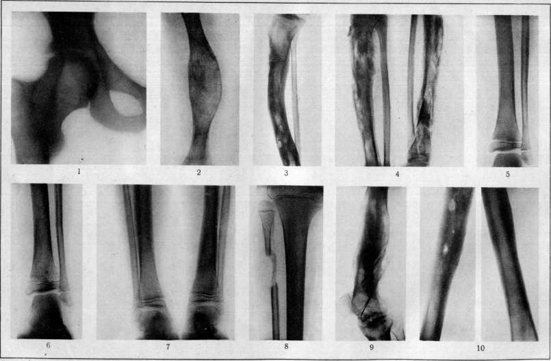 Рентген диагностика остеомиелита Рентген диагностика остеомиелита