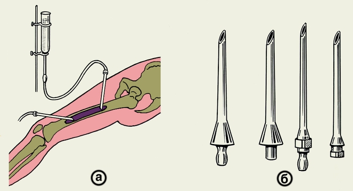 Остеоперфорация Остеоперфорация