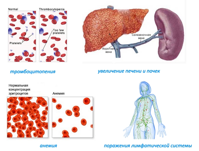 Последствия остеопетроза Последствия остеопетроза