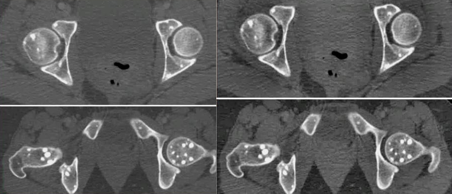 Остеопойкилия костей на МРТ Остеопойкилия костей на МРТ