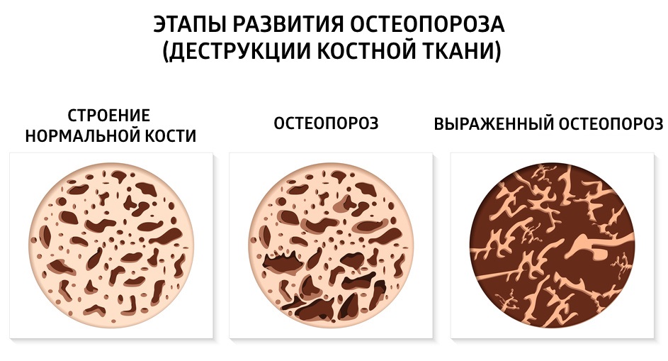 Степени развития остеопороза Степени развития остеопороза