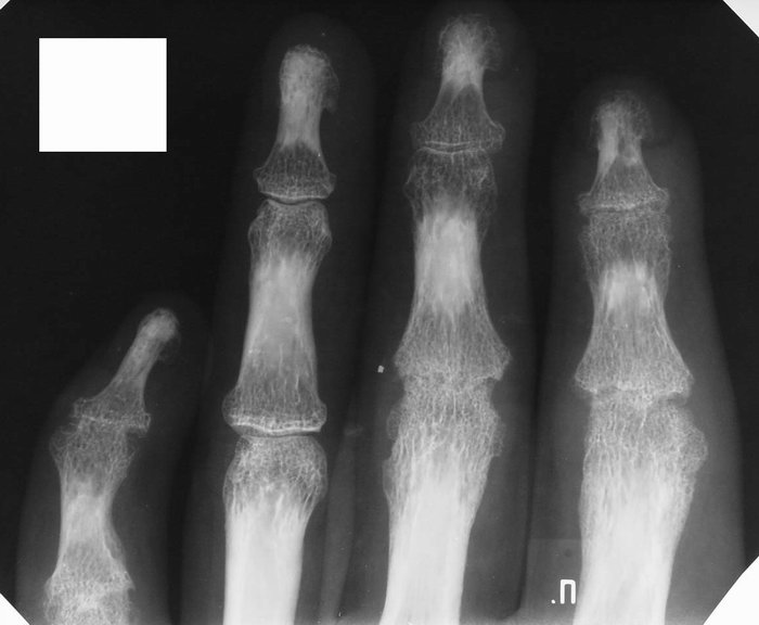 Остеопороз на рентгене Остеопороз на рентгене
