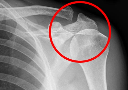 Остеопороз плеча на рентгене Остеопороз плеча на рентгене