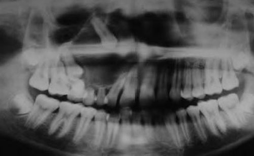 Остеосаркома челюсти Остеосаркома челюсти