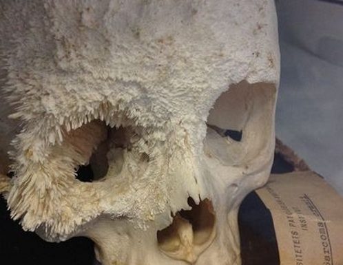 Остеосаркома черепа Остеосаркома черепа