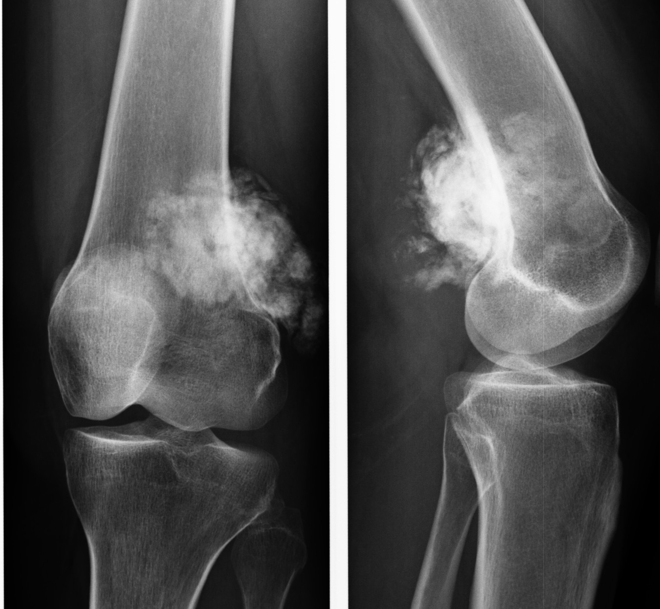 Остеосаркома на МРТ снимке Остеосаркома на МРТ снимке