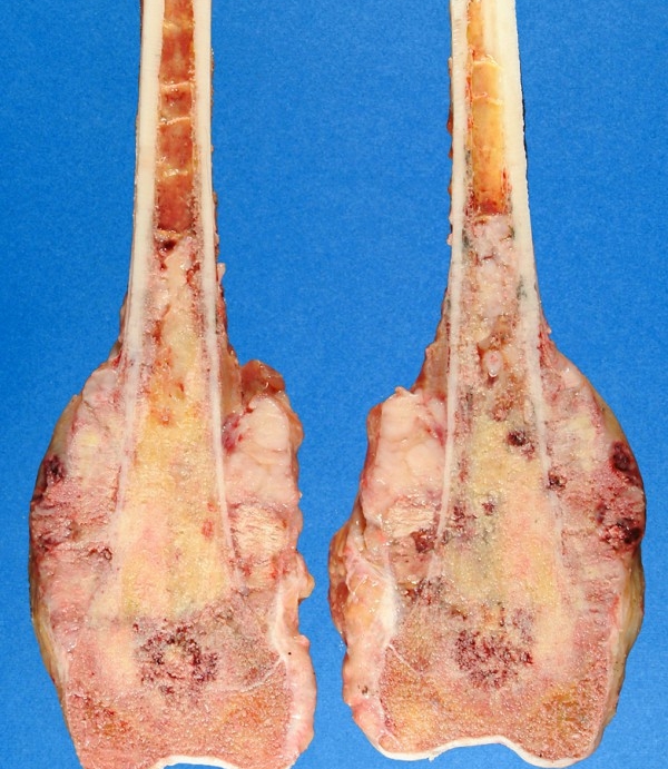 Остеосаркома трубчатых костей Остеосаркома трубчатых костей