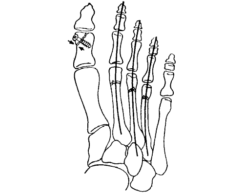 Остеосинтез большого пальца Остеосинтез большого пальца
