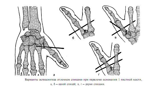 Остеосинтез пальца руки Остеосинтез пальца руки