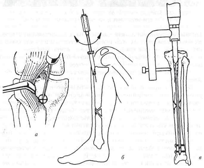 Остеосинтез при переломе голени Остеосинтез при переломе голени