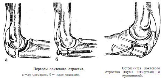 Остеосинтез при переломе локтевого отростка Остеосинтез при переломе локтевого отростка