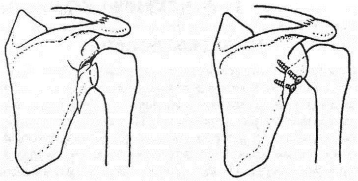 Остеосинтез при переломе лопатки Остеосинтез при переломе лопатки