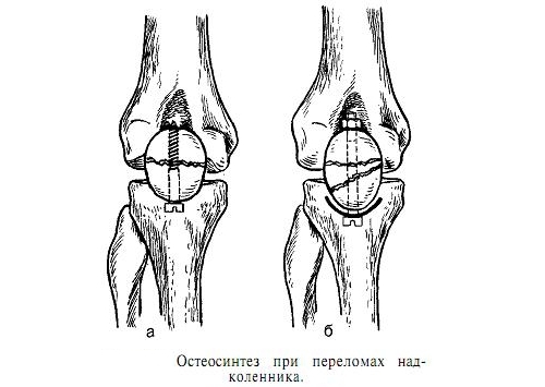 Остеосинтез при переломе коленной чашечки Остеосинтез при переломе коленной чашечки