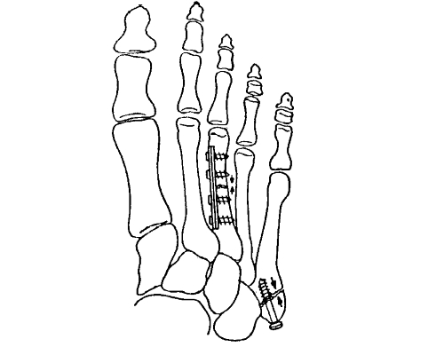 Остеосинтез при переломе плюсны Остеосинтез при переломе плюсны