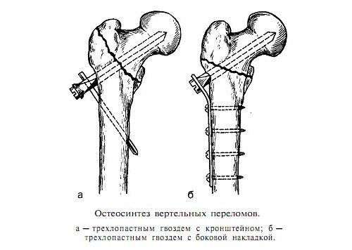 Остеосинтез шейки бедра Остеосинтез шейки бедра