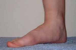 Отечность центральной части стопы Отечность центральной части стопы