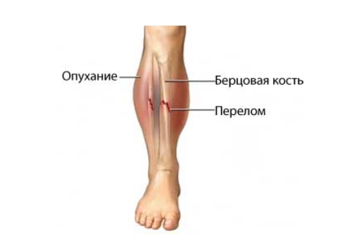 Отек и гематома при переломе берцовых костей Отек и гематома при переломе берцовых костей