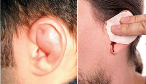 Отек и кровотечение из уха Отек и кровотечение из уха