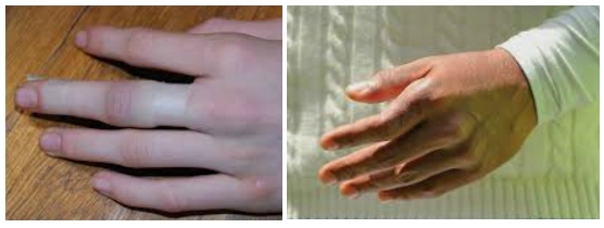 Отек и смещение при переломе пальца Отек и смещение при переломе пальца