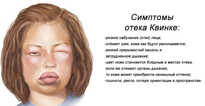 Отек квинке Отек квинке